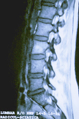 Lumbar Scan